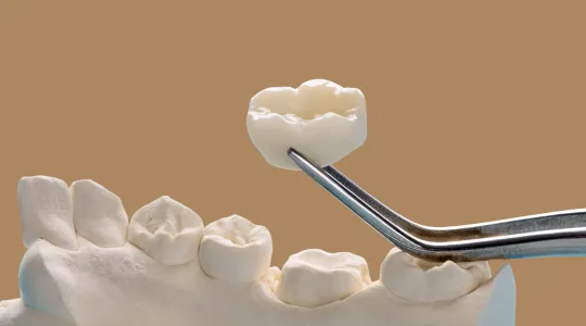 Dental Crowns at Highlandtown Dental Group in Baltimore, Maryland